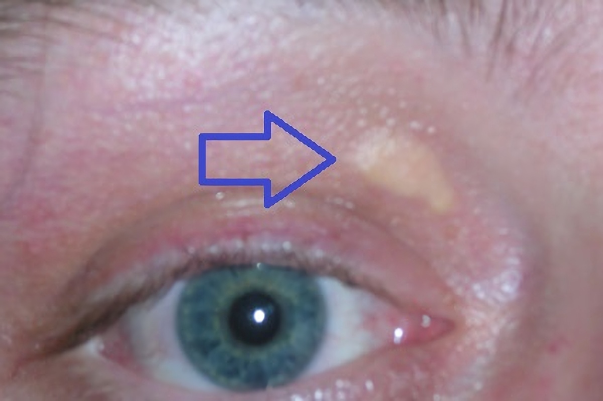 Imagem de referência relacionada a xantelasma, item descrito como registro de referência sobre xantelasma, organizado a partir de dados estruturados abertos