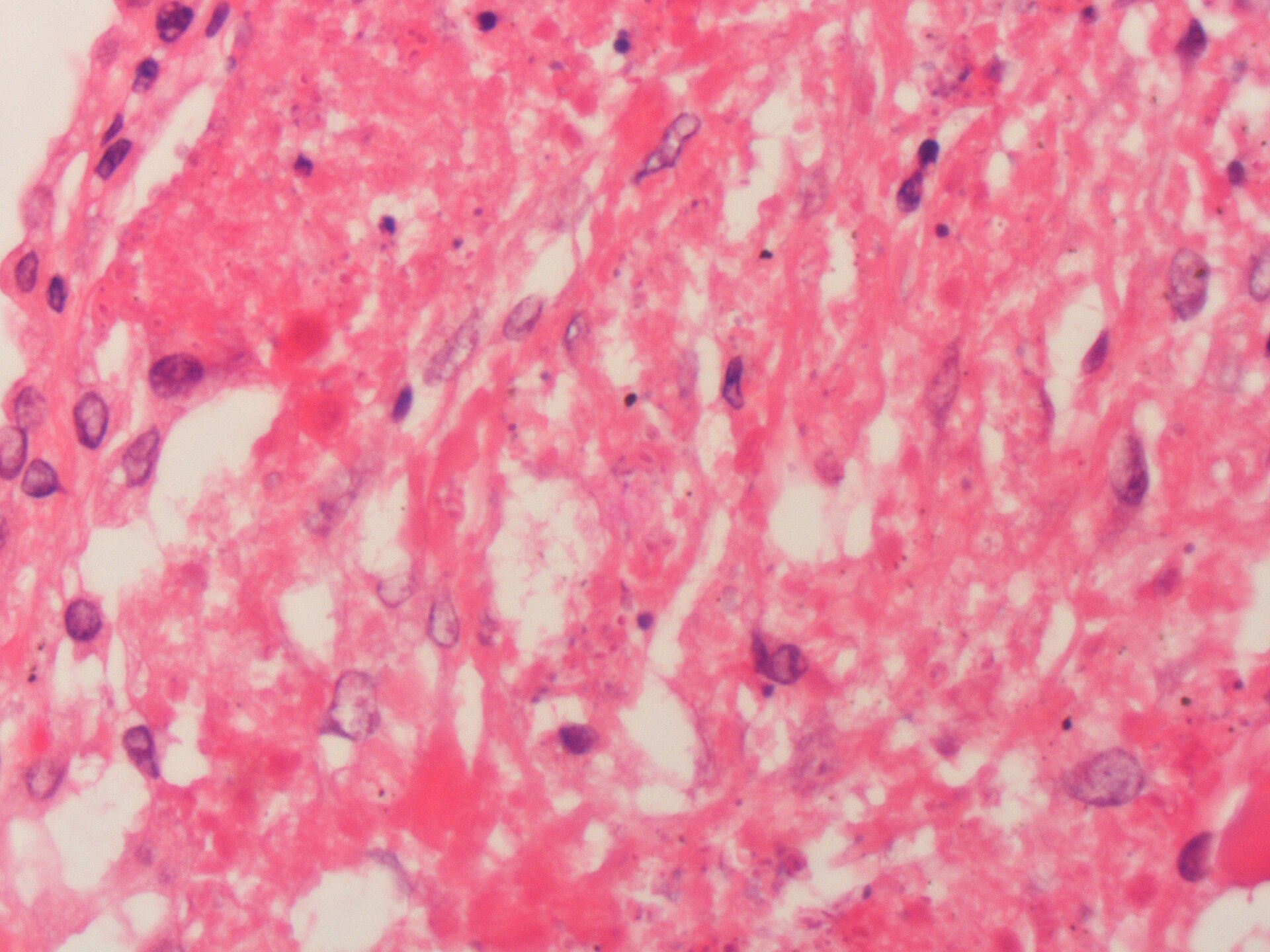 Imagem de referência de histoplasmose, descrito nos dados abertos como infecção fúngica pulmonar ou disseminada