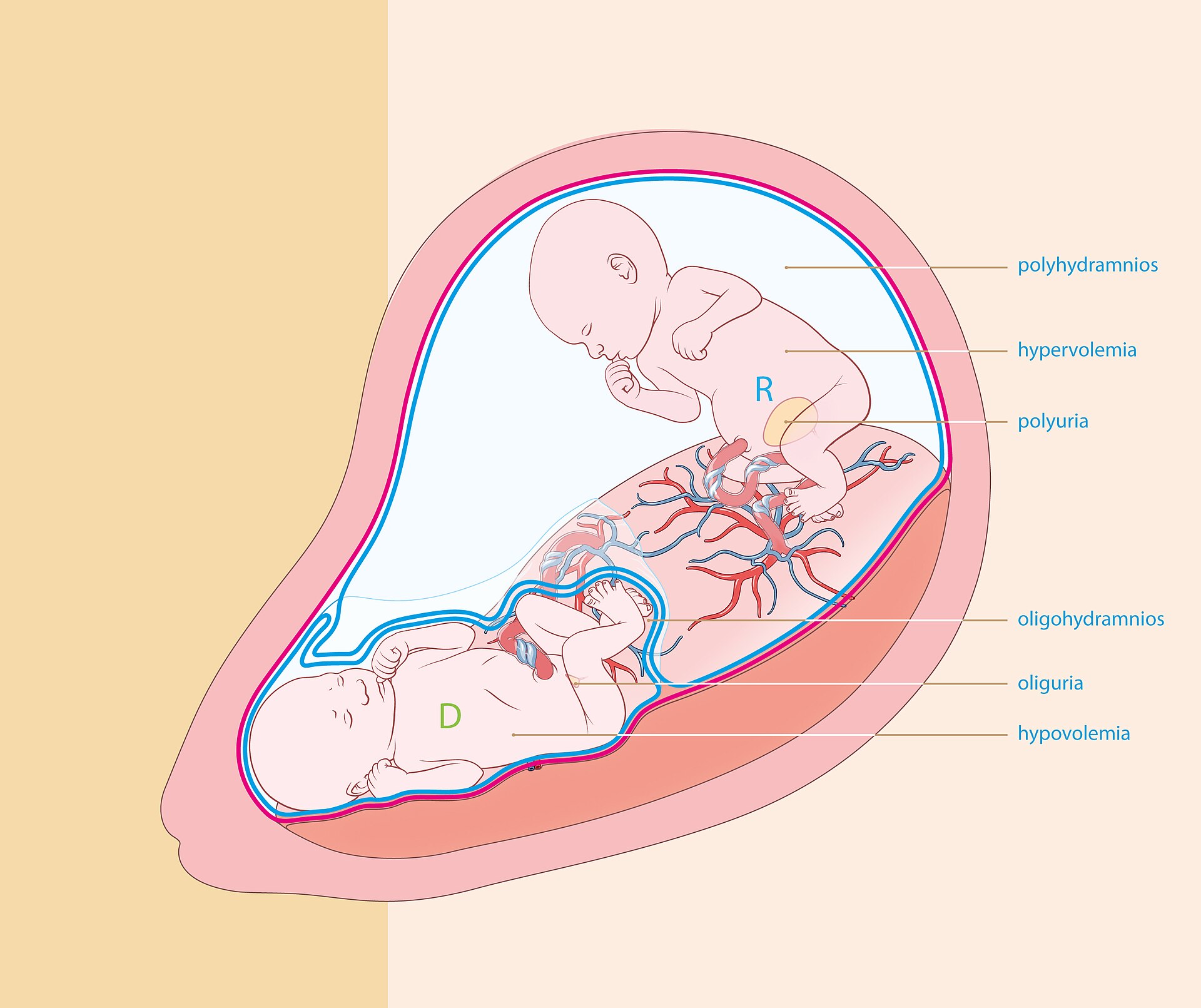 Imagem de referência de Síndrome da transfusão feto-fetal, descrito nos dados abertos como complicação troca de sangue de forma desproporcional, resultando em alta morbilidade
