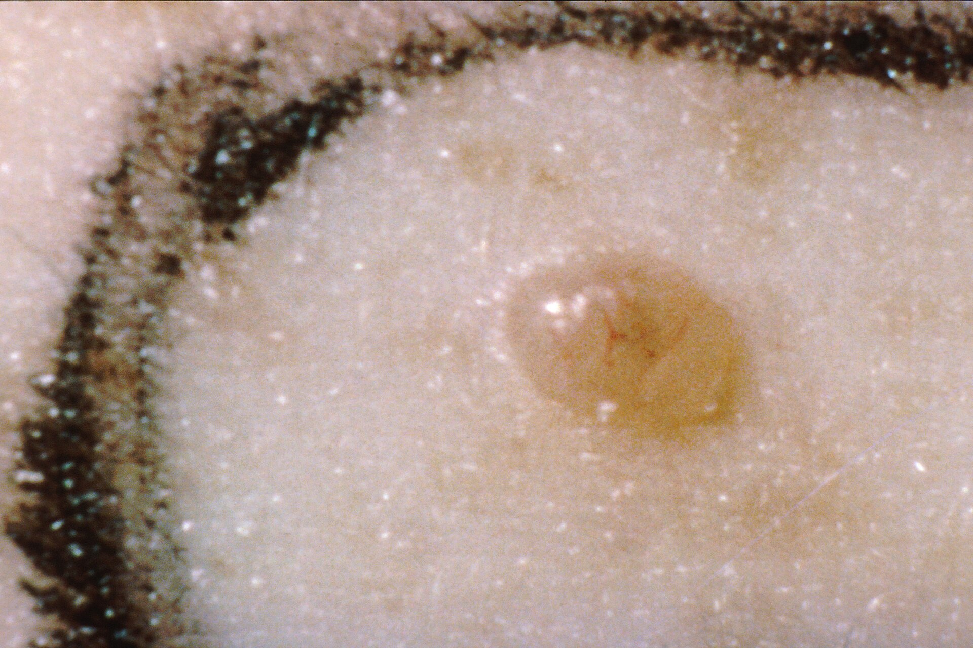 Imagem de referência de cancro da pele, descrito nos dados abertos como neoplasia maligna que surge na pele