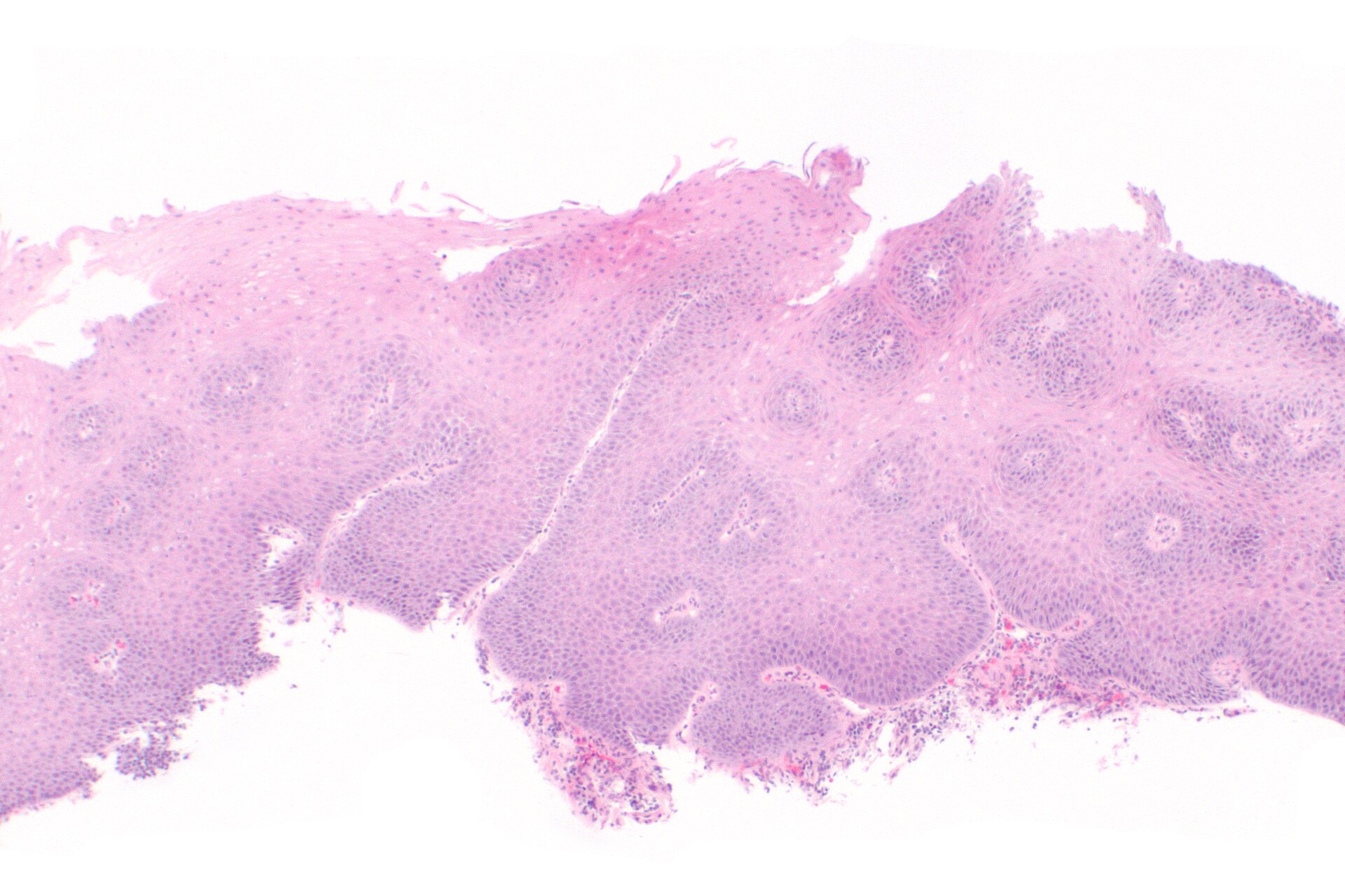 Imagem de referência de doença de refluxo gastroesofágico, descrito nos dados abertos como doença crónica causada pelo refluxo do ácido do estômago em direção ao esófago