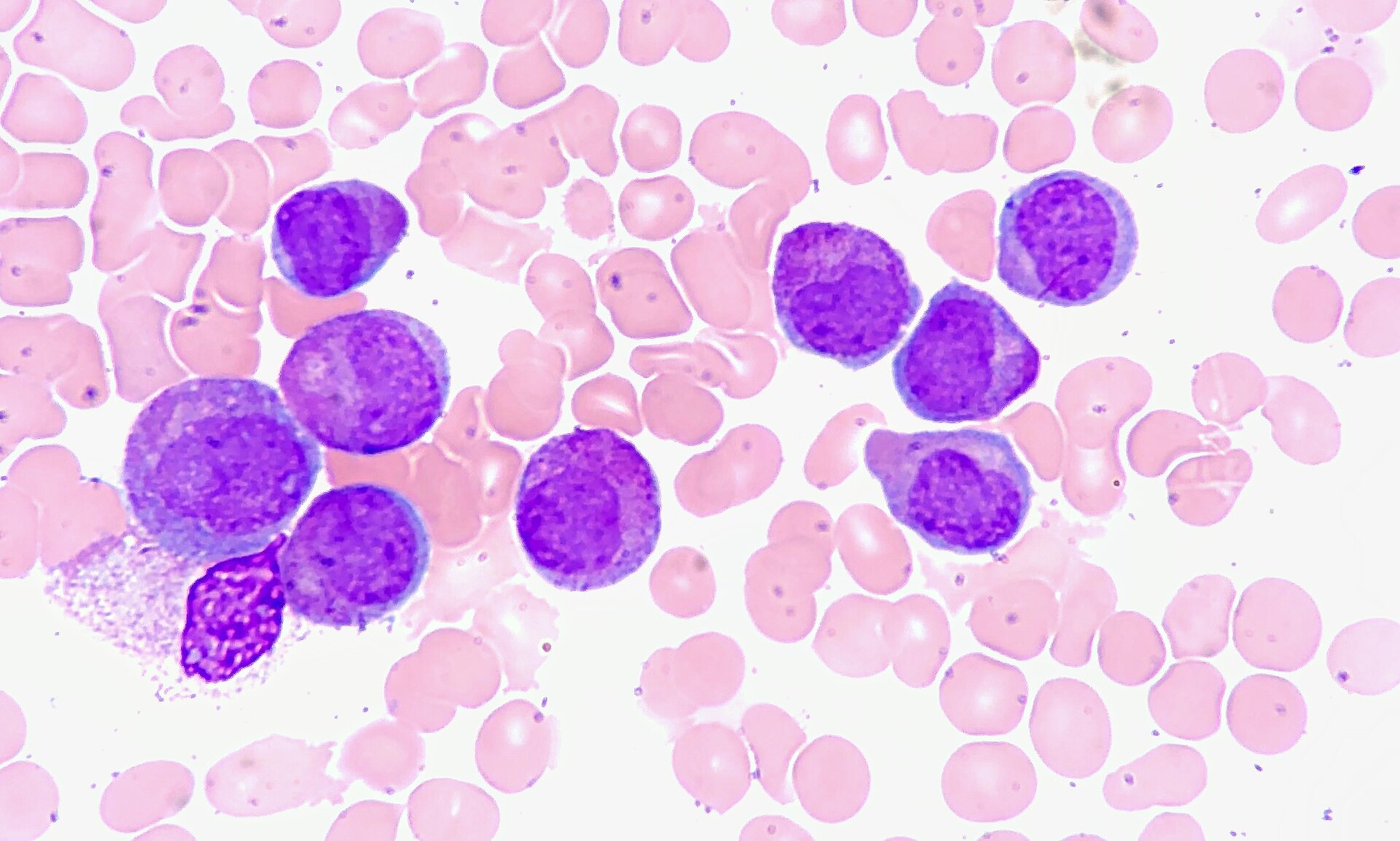 Imagem de referência de leucemia promielocítica aguda, descrito nos dados abertos como subtipo de Leucemia mielóide aguda