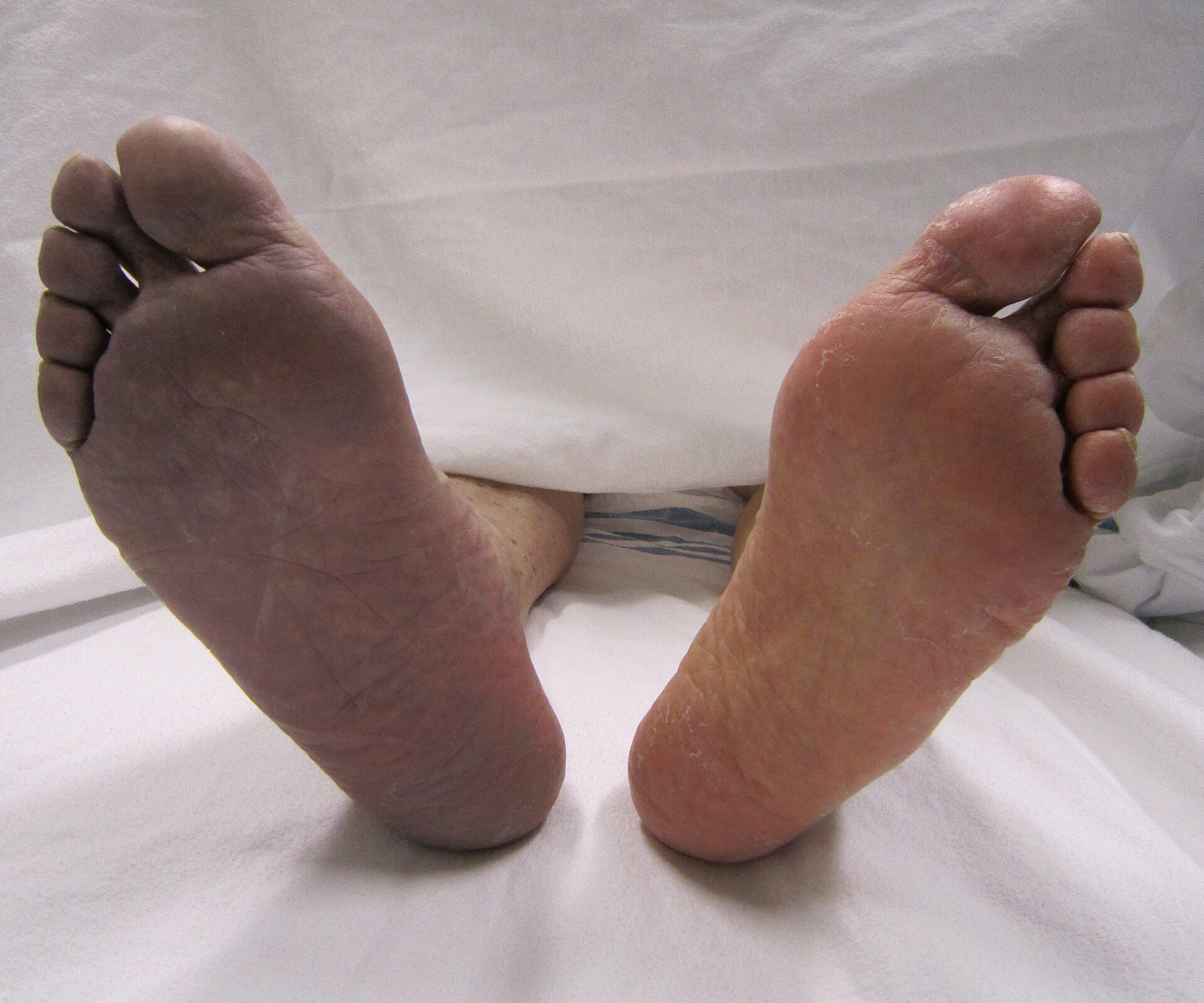 Imagem de referência de trombose, descrito nos dados abertos como doença vascular causada pela formação de um coágulo de sangue dentro de um vaso sanguíneo, obstruindo o fluxo de sangue através do sistema circulatório