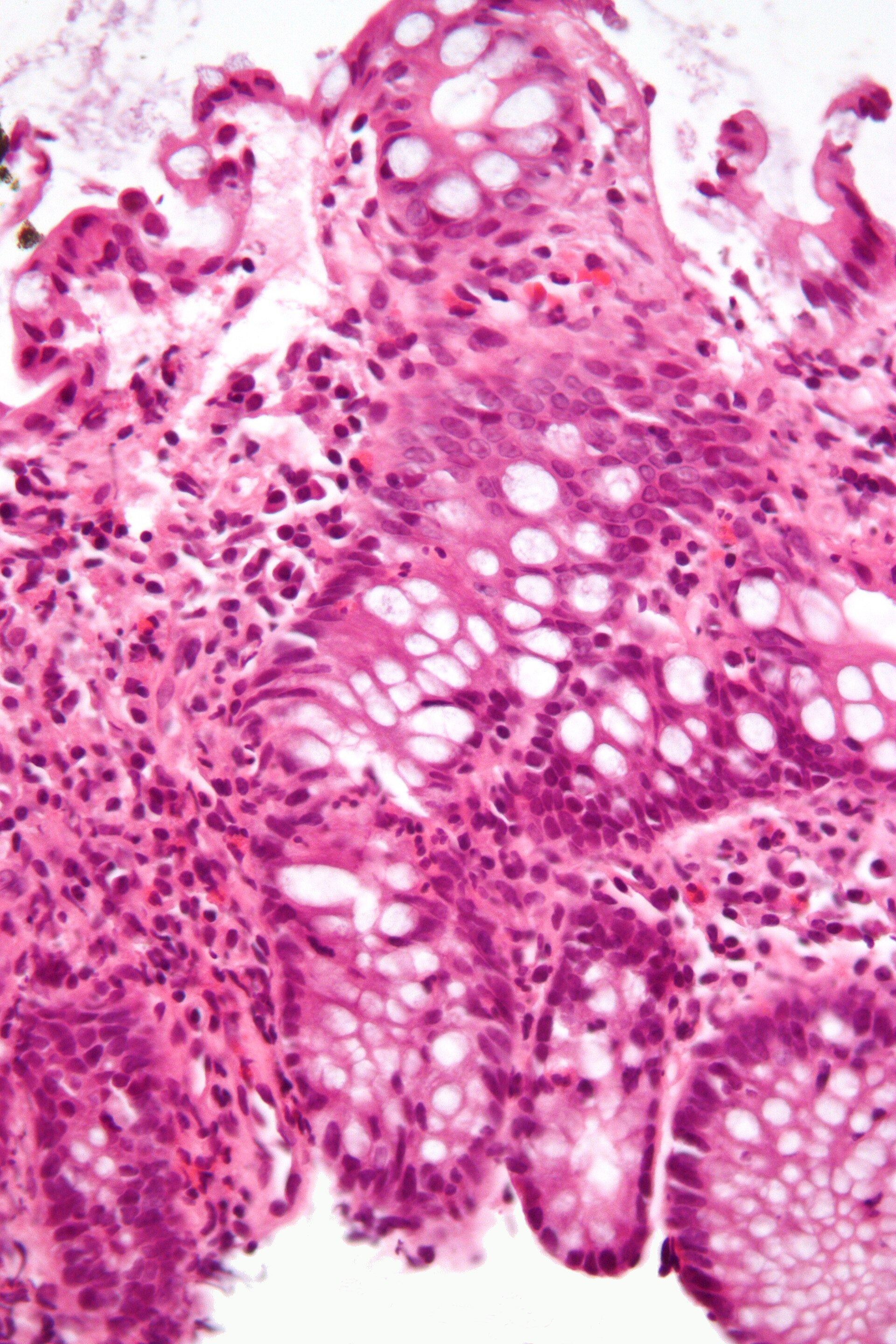 Imagem de referência de colite, descrito nos dados abertos como inflamação do cólon