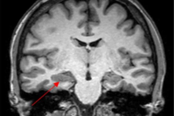 Caso de convulsão na menstruação levanta suspeita de endometriose cerebral