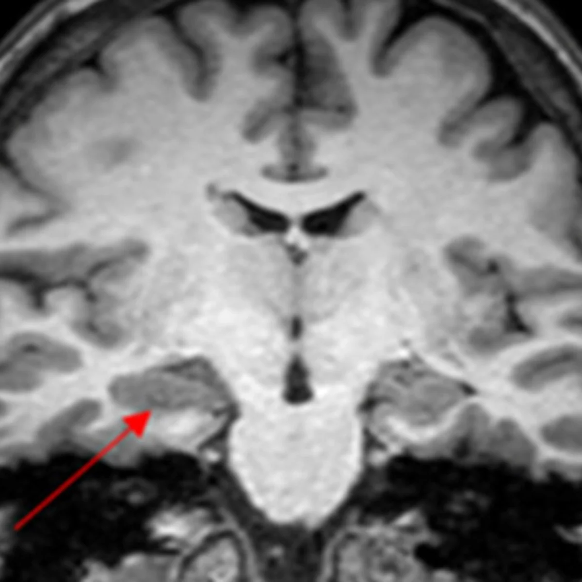 Caso de convulsão na menstruação levanta suspeita de endometriose cerebral