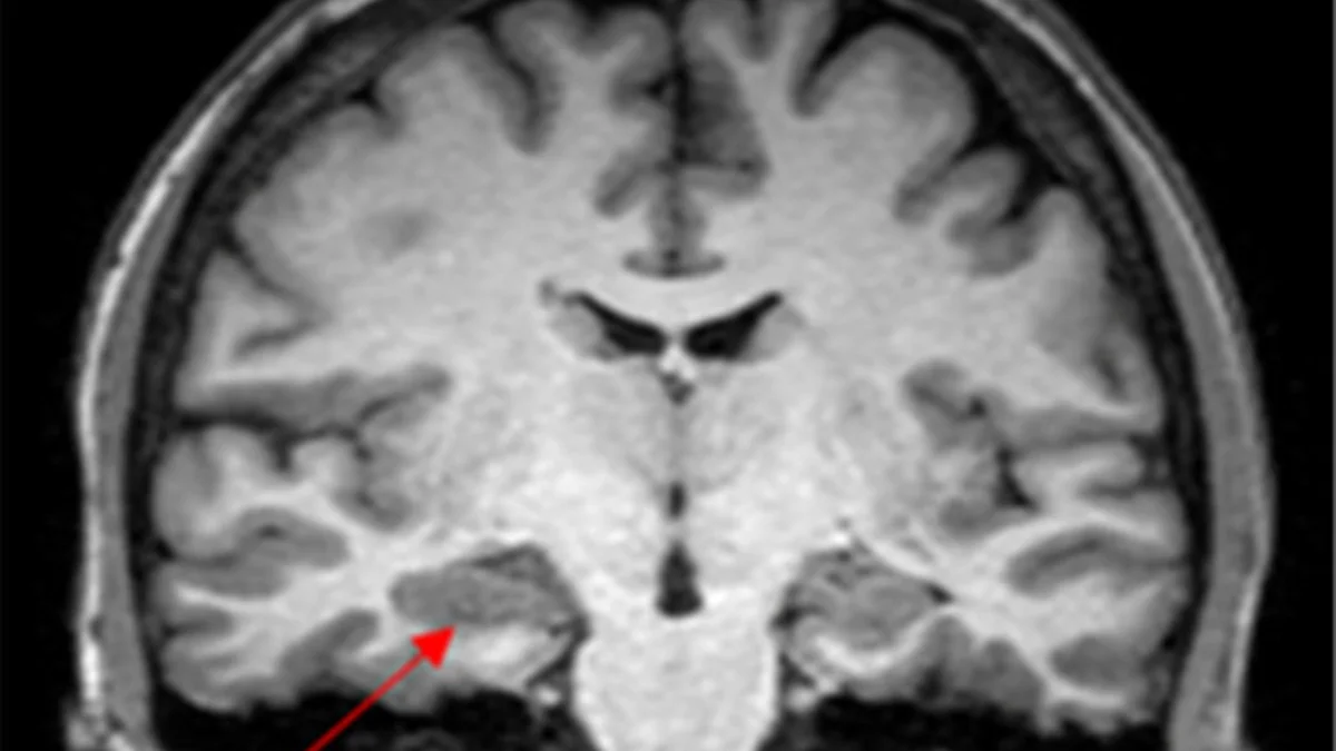 Caso de convulsão na menstruação levanta suspeita de endometriose cerebral