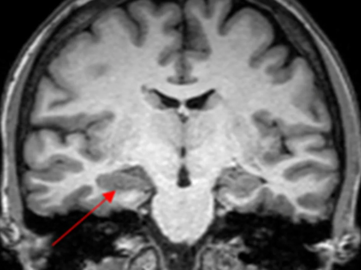 Caso de convulsão na menstruação levanta suspeita de endometriose cerebral