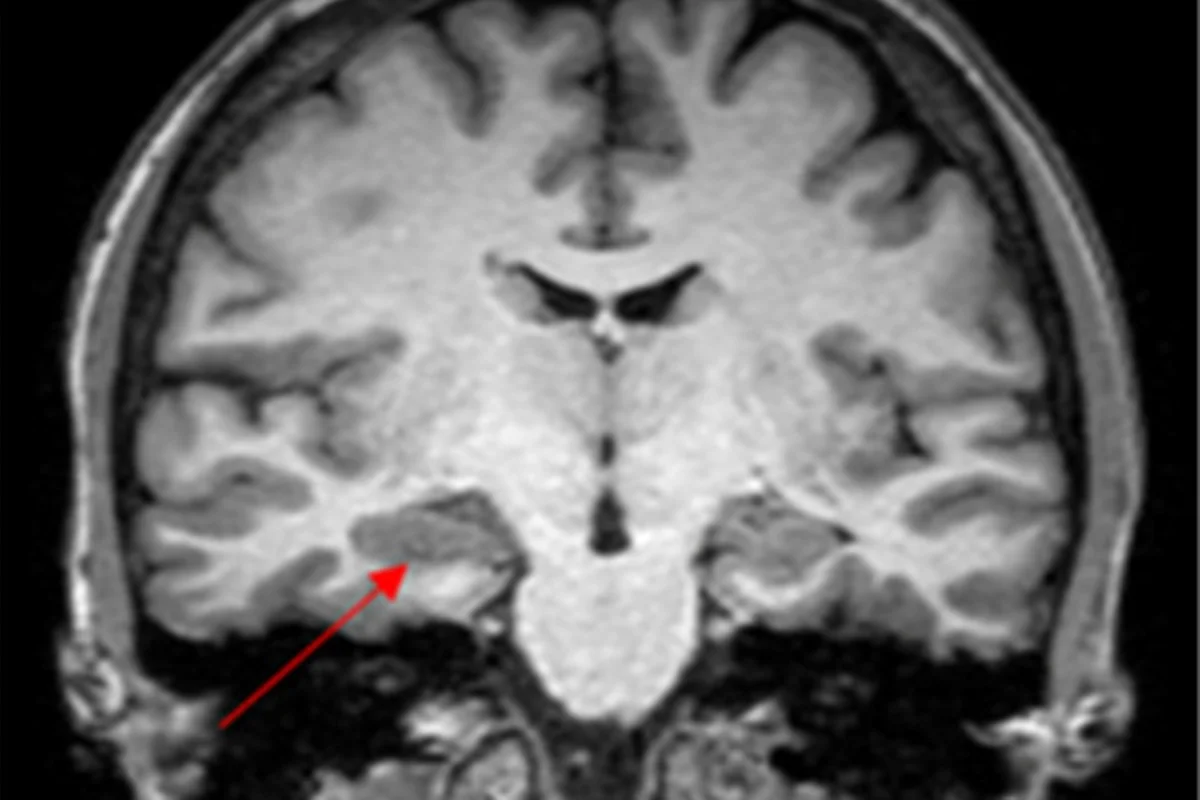 Caso de convulsão na menstruação levanta suspeita de endometriose cerebral